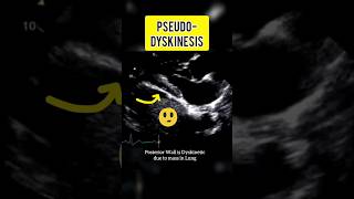 Pseudo Dyskinesia shorts trending echocardiography heartdisease cardiology [upl. by Trev495]