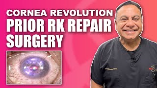 Corneal RK Radial Keratotomy Repair with Topographic Guided Ablation [upl. by Einnek]