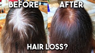 Thinning Hair New Technology  HairMax LaserBand 82 to Regrow Hair [upl. by Pietrek260]