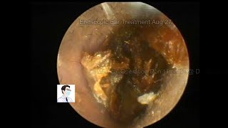 Ear Wax RemovingCerumen embolic processing in 2 cases [upl. by Aceber]