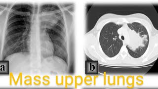 ct scan chest plain  soft tissue mass left lung upper and lover lobs  DD pleural based mass lesion [upl. by Nicolis]