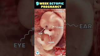 9 weeks ectopic pregnancy 😳 Unusual Pregnancy  Baby outside the uterus shortsvideo pregnancy [upl. by Grimonia]