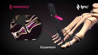 Novastep Lync® Hammertoe Correction System  PIP [upl. by Joane]