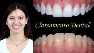 As melhores dicas que te levarão ao sucesso do seu clareamento dental [upl. by Eiramassenav]