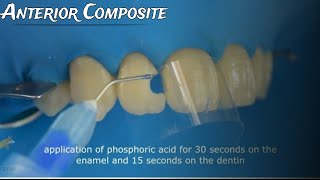 Class III Composite restoration Full case protocol from A to Z [upl. by Aneet400]