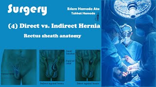 4 Surgery  Rectus sheath anatomy I Direct vs indirect oblique inguinal hernia  Eslam Hamada [upl. by Doble]