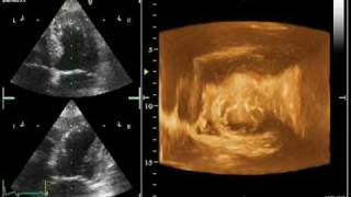 4D ECHO TENDON ANTERO SEPTAL AKINESIA [upl. by Scammon]