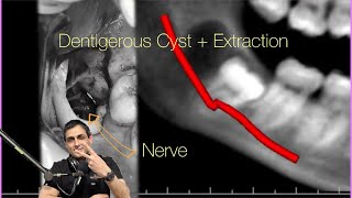 Dentigerous Cyst and Lower Wisdom Tooth with Four Roots Watch my podcast DrWahanExperiment [upl. by Eliath]