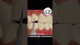 Restore your broken toothoraismilezone drrichadubey tooth dentalcare shortsfeed shorts [upl. by Ydde519]