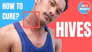 How to treat Hives Urticaria  Doctor Explains [upl. by Lazaro353]