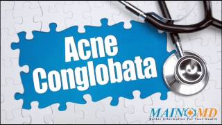 Acne Conglobata ¦ Treatment and Symptoms [upl. by Moskow20]