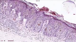 Superficial Spreading Melanoma  Histopathology [upl. by Laroy247]