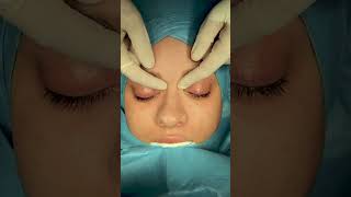 Rhinoplasty Surgery in Turkey By Dr Bora Ok [upl. by Eyt]