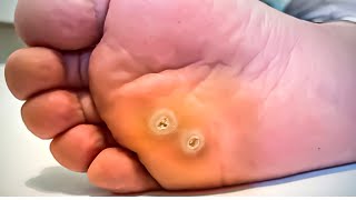 How To Remove a Foot Corn or Callus Foot Doctor Home Treatment [upl. by Kahn498]