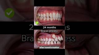 braces are very crooked braces process braces orthodontist dentist dental shorts viral [upl. by Sidnak552]