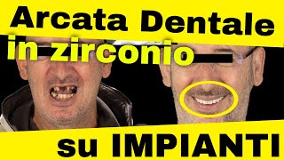 Arcata dentale su impianti con lo zirconio [upl. by Yoc]