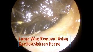 Large amount of ear wax removed with suction and jobson Horne  Ep 06 [upl. by Eaner]