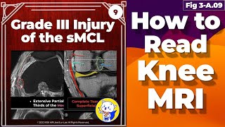 Fig 3A09 Grade III Injury of the sMCL and Medial Patellofemoral Ligament Injuries [upl. by Koren]