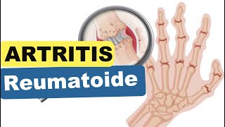 ARTRITIS REUMATOIDE  Síntomas Diagnóstico Tratamiento [upl. by Aihsilat548]