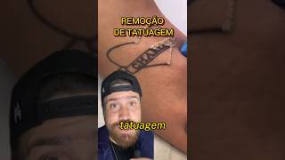 REMOÇÃO DE TATUAGEM🔥 tatuagem tattoo [upl. by Keary]