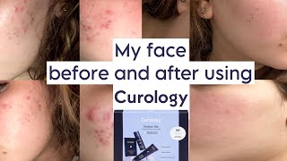 My face before and after using CUROLOGY  honest review NOT SPONSORED [upl. by Hearsh]