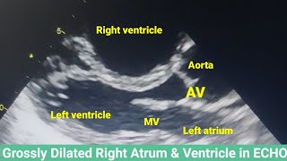 Dilated right heart in Echo Echo features of Pulmonary hypertension Dilated RV and RA [upl. by O'Shee]