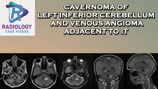 Cavernoma of left inferior cerebellum and venous angioma adjacent to it [upl. by Hadley]