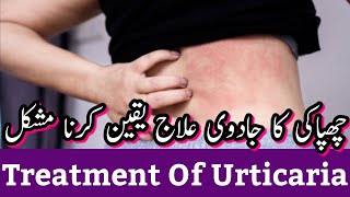 Urticaria Treatment Home Remedy In Urdu  Urticaria Ka Ilaj In Urdu [upl. by Ayikahs]