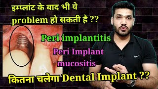 डेंटल इम्प्लांट में होने वाली प्रॉब्लम  Peri implantitis amp peri implant mucositis [upl. by Hesky583]