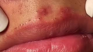 Most Painful Blackhead Removal on Lips [upl. by Sirrad372]