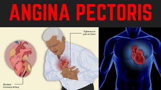 ANGINA PECTORIS  Chest Pain  Types  Causes Risk factors  NITROGLYCERIN  Management [upl. by Anniram]