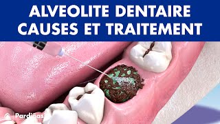 ALVÉOLITE DENTAIRE  Infection après extraction dentaire causes et traitement © [upl. by Teador]