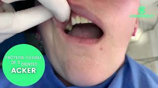 PRÓTESIS parcial flexible de 3 dientes ACKER [upl. by Breger724]