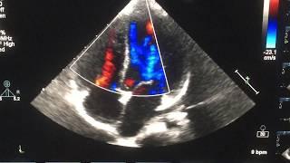 Ventricular Septal Defect Associated With Aneurysm of the Membranous Septum Echocardiography [upl. by Leblanc]