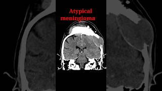 Meningioma shorts radiology education radiologyjunction [upl. by Pietro251]