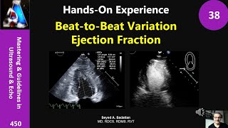 HandsOn Experience 38 BeattoBeat Variation amp Ejection Fraction [upl. by Codie]