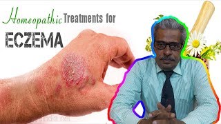 Eczema Dermatitis Treatment in Homeopathy by Dr PS Tiwari [upl. by Grove]