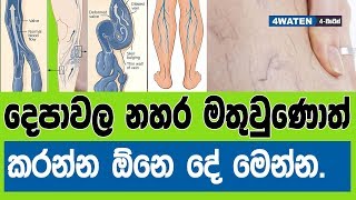 දෙපාවල නහර මතු වුණොත් කරන්න ඕනෙ දේවල් මෙන්න  What should you do if you have varicose veins 2019 [upl. by Hammad]