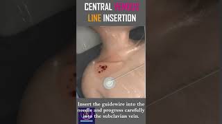 Central Venous Line Insertion  Step By Step Procedure  shorts [upl. by Jeromy754]