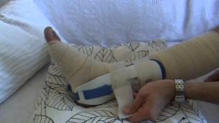 day 6 resprained same ankle bandage and ankle brace [upl. by Ruthann]