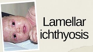 Dermatology lecture  genodermatosis ichthyosis lamellar ichthyosis [upl. by Massey]