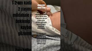 GÖBEK FITIĞI ingherni herni inguinalherni baby babylove babies emzirme bebekbakımı [upl. by Lucey]