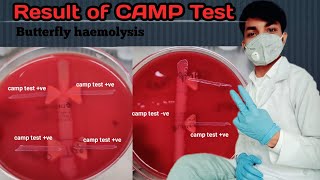 CAMP Test result  Butterfly haemolysis  CAMP Test factor  ve amp ve CAMP Test  Enhanced Haemolys [upl. by Eugirne]