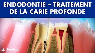 Endodontie  Traitement de la carie profonde © [upl. by Calla42]