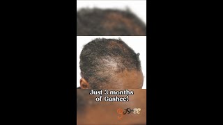 What 3 Months of Gashee Can Do for Traction Alopecia [upl. by Harmon]