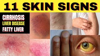 ⚠️ 11 Skin Signs of Cirrhosis Liver Disease amp Fatty Liver  Longevity Deprocessed [upl. by Peednas]