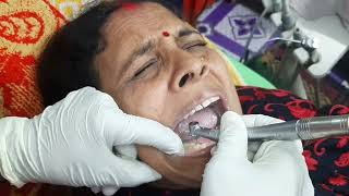 Apex locator Diye kivabe root canal kurte hoi chambar Auro dental care 01739117120 [upl. by Maddy]