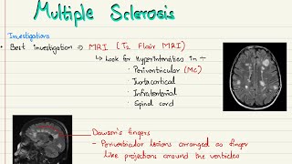 Multiple sclerosis pathophysiology classificationfeatures Mc Donald’s criteria and treatment [upl. by Archibald]