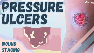 Pressure Ulcers Wound Staging Nursing [upl. by Barnaba]