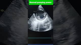 Dilated cardiomyopathy with spontaneous Echo contrast shorts echo [upl. by Diaz]